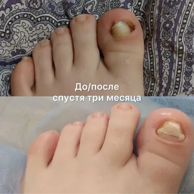 Маникюр#педикюр#Запорожье# - До и после#комбинированный педикюр#аппаратный  и кислотный#покрытие гель-лаком#ухоженные ножки#для Наталии# | Facebook
