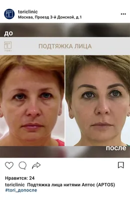 Подтяжка лица нитями Аптос (Aptos), цены в Москве