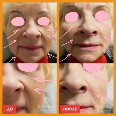 Нити APTOS фото до и после процедуры установки нитей в клинике в Москве -  Cosmetic-clinic