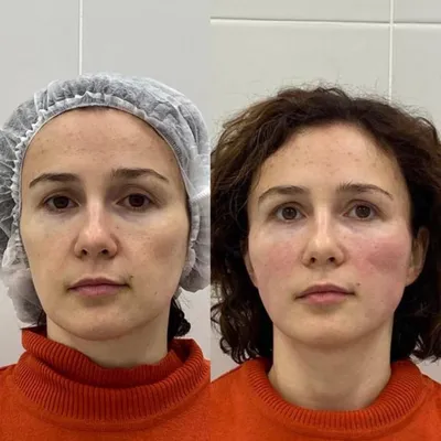 Результат подтяжки лица нитями Аптос, фото до и после, 2 фото, Москва