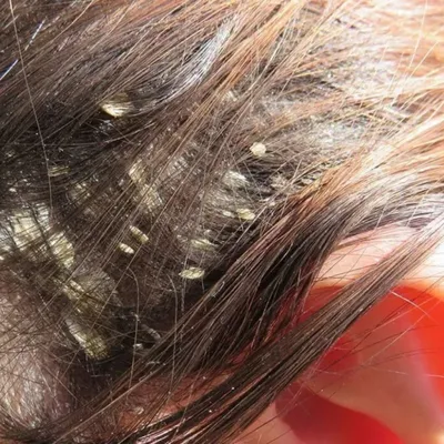 МЦ \"Лазер+Эстетика\" on Instagram: \"Лечение заболеваний волосистой части  головы. Врач Мурадова Малика Мусаевна правильно поставила диагноз во время  мезотерапии - асбестовидный лишай. На фото вы можете наблюдать, что кожа  очистилась. 💯Акции по