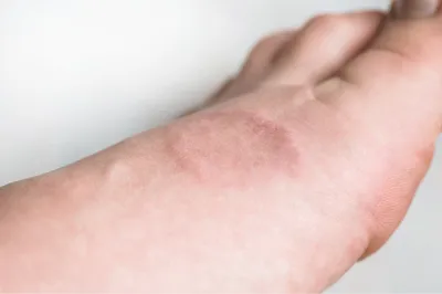 Себорейный дерматит | причины, симптомы, лечение и диагностика
