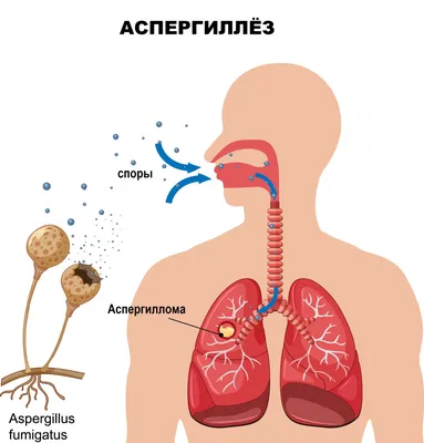 Аспергиллез - причины появления, симптомы заболевания, диагностика и  способы лечения