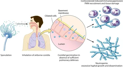 Онлайн Академия для умных врачей \"Uniprof\" - Грибы Aspergillus в организме  молодого парня В марте ко мне обратился пациент с жалобами на постоянную  слабость. Молодой человек учился на дневном отделении, еще год