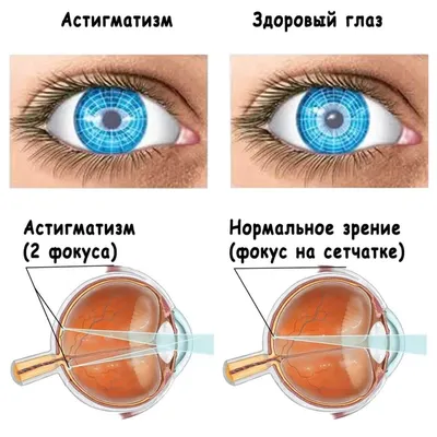 Астигматизм глаза, причины, симптомы, лечение - cmg-zokb.com.ua