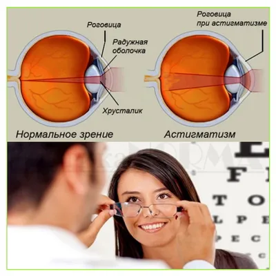 Астигматизм: причины, виды, симптомы, лечение, диагностика - клиника  ЭлитПлюс