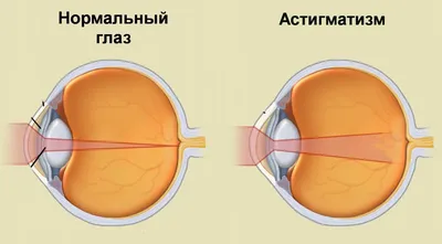 Если предметы выглядят нечетко и размыто, есть подозрение, что у вас  астигматизм! Что дальше? -