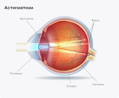 Что такое астигматизм?