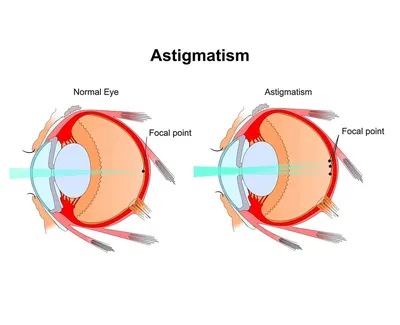 Упражнения для глаз при астигматизме — полезная гимнастика