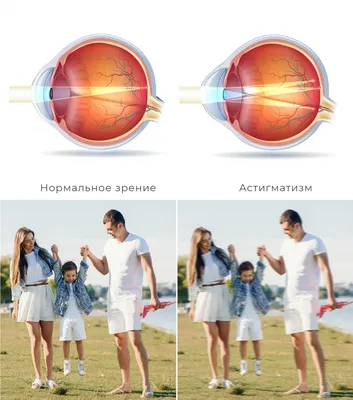 Астигматизм — что это такое, симптомы, диагностика зрения. Как лечить астигматизм  глаз. Противопоказания. Лечение в офтальмологии.