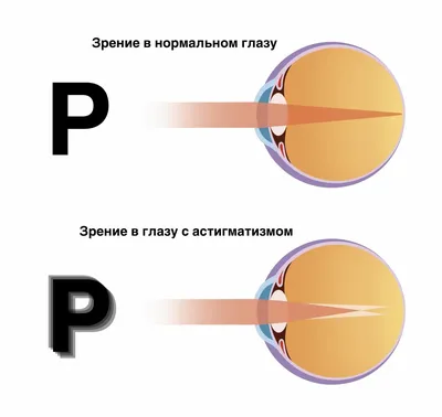 Отвечаем на вопросы о Вашем зрении - Всем известно, что эталоном нормы  зрения является 1,0. А такие нарушения зрения как близорукость (миопия) и  дальнозоркость (гиперметропия) легко поддаются коррекции очками или  контактными линзами.