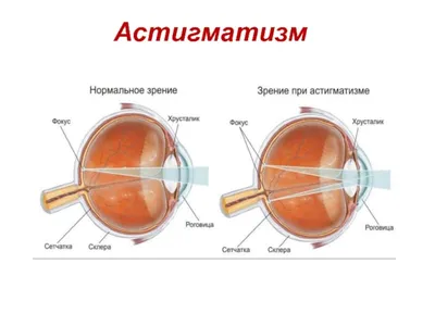 Лечение астигматизма в СЗАО (м.Щукинская, м.Стрешнево, м.Сокол)