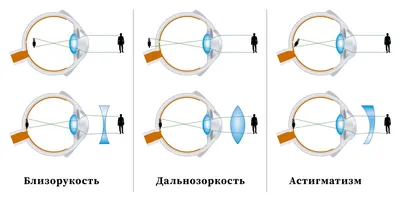 Астигматизм лечение в Москве - Методы лечения