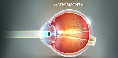 АСТИГМАТИЗМ - Центр охраны зрения