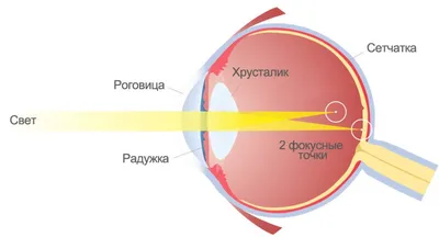 Глазная клиника \"ОфтальНова\" - АСТИГМАТИЗМ – дословно переводится как  «отсутствие стигмы», т.е. «общей точки». Это оптический дефект, при котором  оптическая система глаза не может собрать на сетчатке световые лучи в  единый чёткий