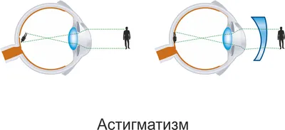 Астигматизм - лечение у детей: диагностика астигматизма у ребенка в Самаре