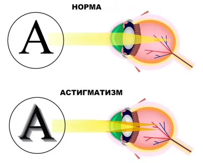 Что ищут офтальмологи у пациентов с астигматизмом? - ЯПлакалъ