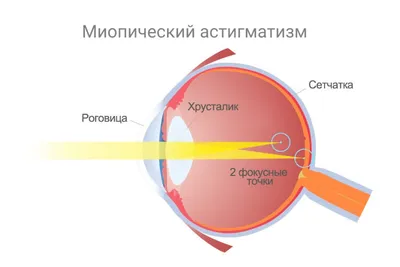 Астигматизм ✓ что это такое, как видят люди с астигматизмом: миопический,  смешанный