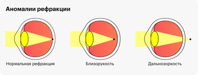 Как узнать, что у вас астигматизм? – Це Клініка