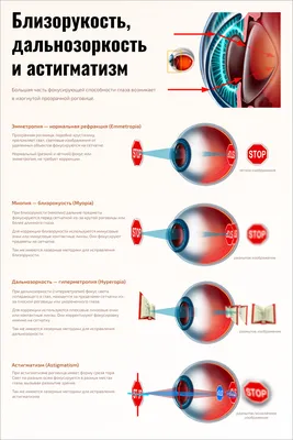Как лечить астигматизм - Центр микрохирургии глаза доктора Шаталова