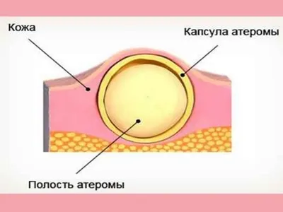 ᐉ Лечение и удаление атером, фибром лазером в Алматы, цена, отзывы — MLC