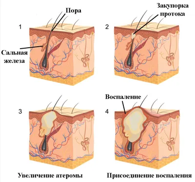 Атерома: фото, на голове, за ухом, на спине, лечение, удаление