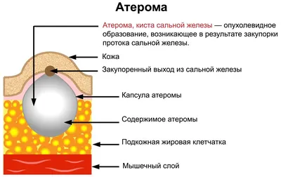 Медицинский центр \"Элегия\" - ❓😱 ЖИРОВИКИ - ЕСТЬ ЧЕГО БОЯТЬСЯ 😱❓ ⠀⠀⠀  Сегодня наш дерматолог рассмотрит проблему атеромы (жировики). ♨️ Итак,  атерома – это доброкачественная кожная опухоль, которая формируется из  клеток сальных