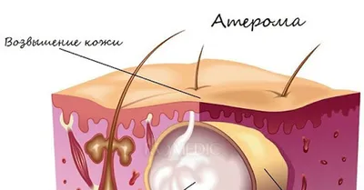 Медичний Центр Країна Здоров'я - Атерома: удалять или оставить? Что такое  атерома? Если нарушается обмен веществ, формируется затруднение с  отделением кожного сала или оно полностью прекращается, наружное отверстие  желез закупоривается, что приводит