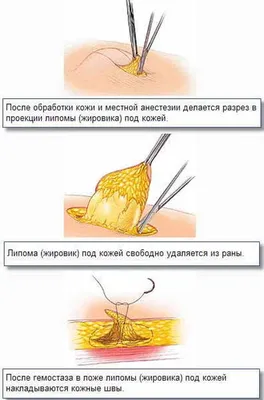 Атерома - причины появления, симптомы заболевания, диагностика и способы  лечения