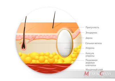 2.7. Атеромы, абсцессы и флегмоны кожи грудной стенки