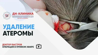 Клиника Мединнова - Вчера возникло много вопросов о том, почему возникает  атерома, и будет ли шрам после удаления. Поэтому я сделаю репост своей  публикации трёхлетней давности, т.к. случай максимально похож на вчерашний.