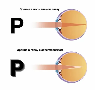 Клиника Мединнова - Вчера возникло много вопросов о том, почему возникает  атерома, и будет ли шрам после удаления. Поэтому я сделаю репост своей  публикации трёхлетней давности, т.к. случай максимально похож на вчерашний.