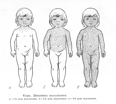 Корь симптомы у детей и взрослых, способы лечения, профилактика и прививки  - статья лаборатории ДНКОМ