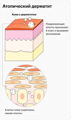 Атопический дерматит у детей: лечение, причины, симптомы, факторы риска