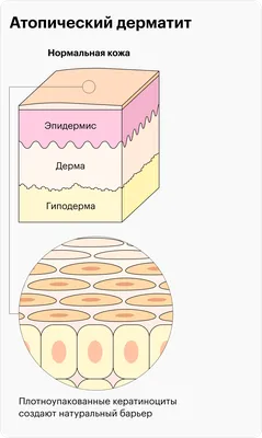 Атопический дерматит — симптомы, причины, лечение атопичной кожи