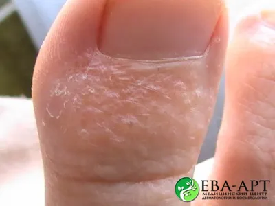 Экзема - атопический дерматит, сухость кожи - причины и лечение —  Лактофильтрум
