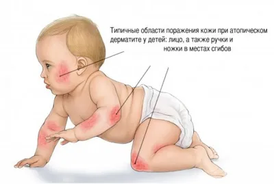 Аллерголог Феденко объяснила, чем атопический дерматит отличается от экземы  - Газета.Ru | Новости