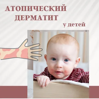 Диагностика и лечение дерматитов — Многопрофильная клиника Н.Березиной  Ульяновск