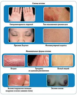 Атопический дерматит - причины, симптомы, диагностика, лечение и  профилактика