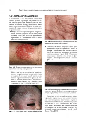Лечение атопического дерматита - Центр европейской дерматологии