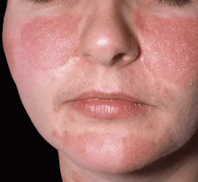 атопический дерматит экзема сухая кожа разрушает влагозащитный барьер,  который позволяет проникнуть во внешний стимул. концепция з Иллюстрация  штока - иллюстрации насчитывающей нерв, воспаление: 256932549