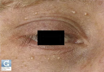 Как убрать морщины под глазами - эффективные процедуры косметологии - ЦИДК