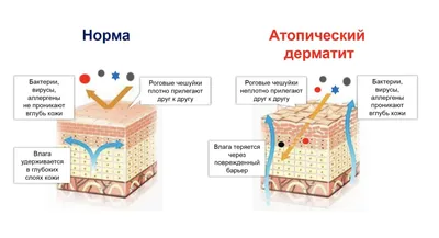 Атопический дерматит на лице и теле у взрослых - лечение в СПб