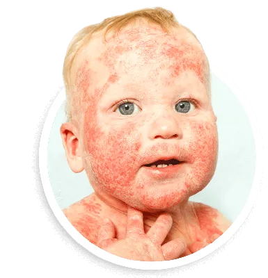 ОБЪЯВЛЕНИЕ атопического дерматита, также известное как атопический Eczema,  тип воспаления дерматита кожи Стоковое Изображение - изображение  насчитывающей дерматит, болезнь: 134775407