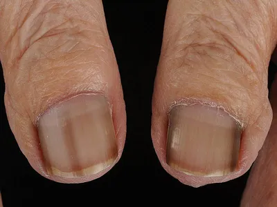 Ониходистрофия, деформация ногтей: причины, лечение, фото