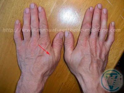 Что значат белые точки на ногтях и как избежать их появления