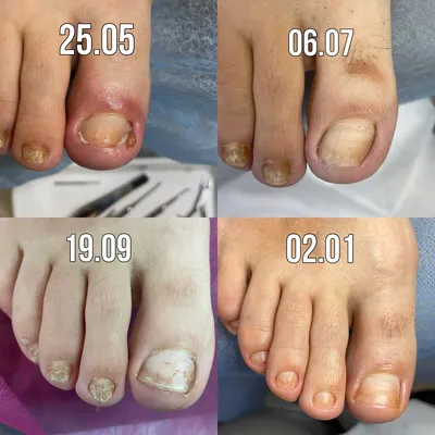 Жидкость для восстановления ногтей против инфекции Paronychia Onychomycosis  Лечение грибка ногтей эссенция для ухода за ногтями | AliExpress