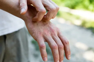 Авитаминоз на руках: лечение и симптомы на фото
