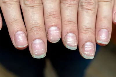 Авитаминоз весны ногтей стоковое изображение. изображение насчитывающей  здорово - 134936127