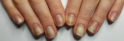 Грибок или нехватка витаминов: причины ломких ногтей и появления белых  пятен - Здорово